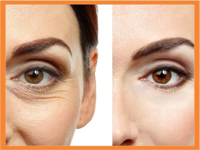 Blepharoplasty