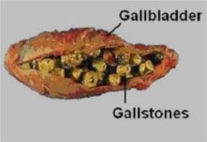 Gallastone2