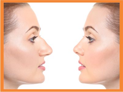 rhinoplasty